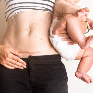 Gel de silicon pentru cicatrici – Stratamed | Optimizarea procesului de cicatrizare